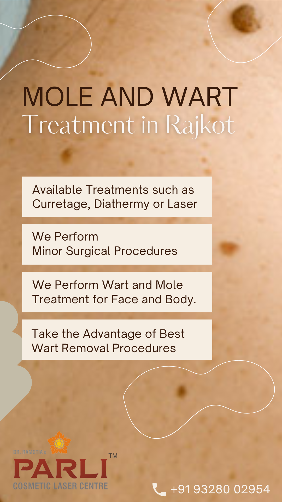 Mole And Wart Removal Treatment In Rajkot PARLI Wart Removal In