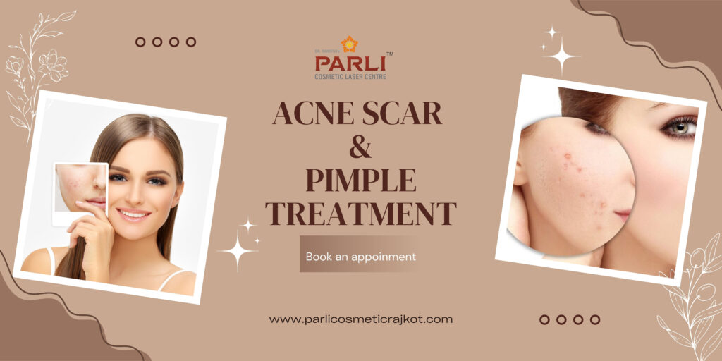 Acne Scar Pimple Treatment in Rajkot