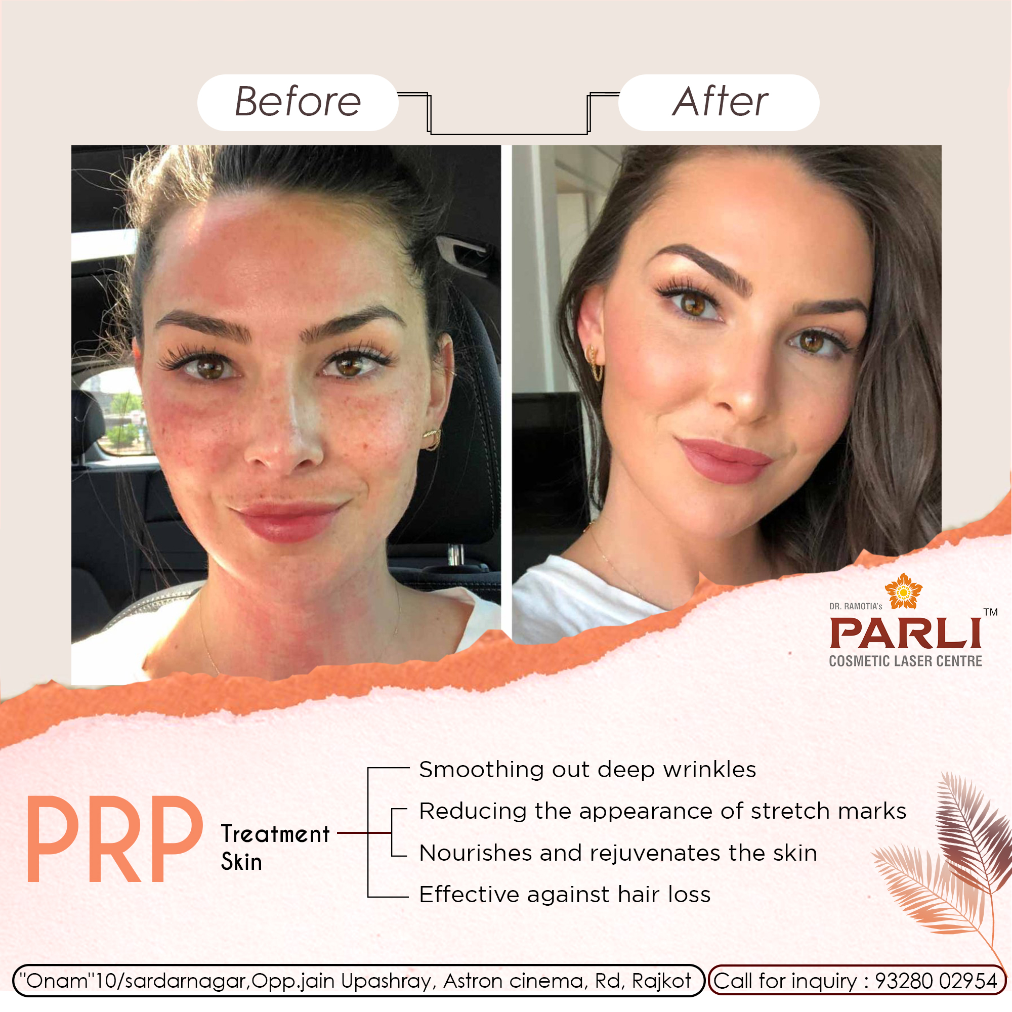 PRP Therapy Skin
