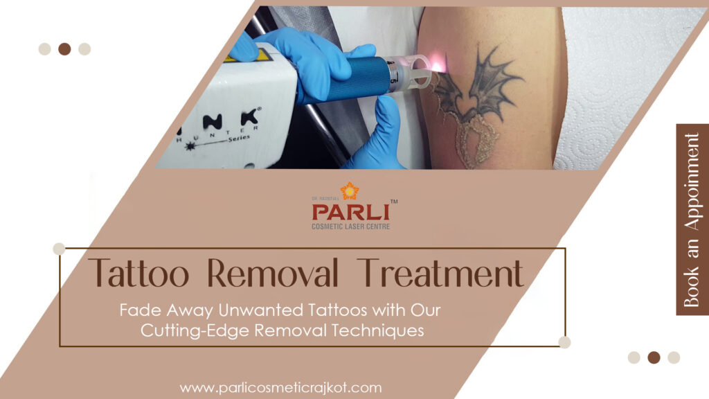 Laser Tattoo Removal Treatment in Rajkot